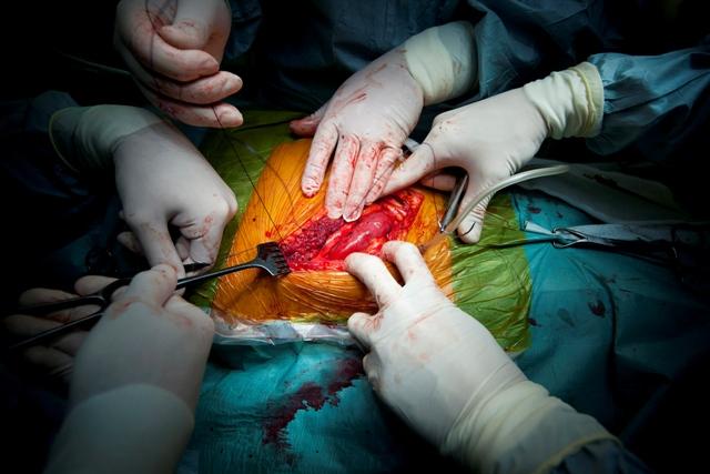 transplantacija organa, EPA/Balaz Mohai